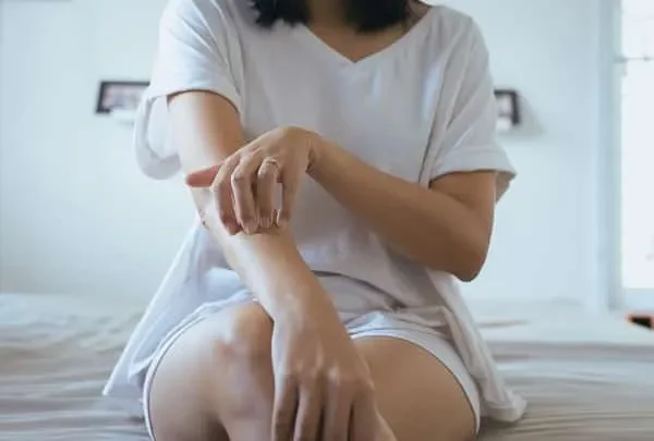 Natural Remedies To Treat Eczema