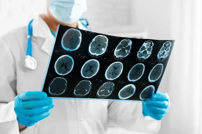 What Really Causes Strokes in Seniors?